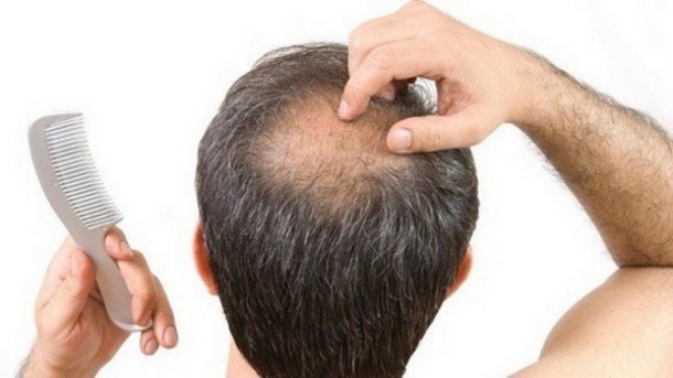 how to regrow receding hair naturally